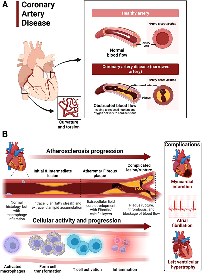 Coronary Artery Disease (CAD)