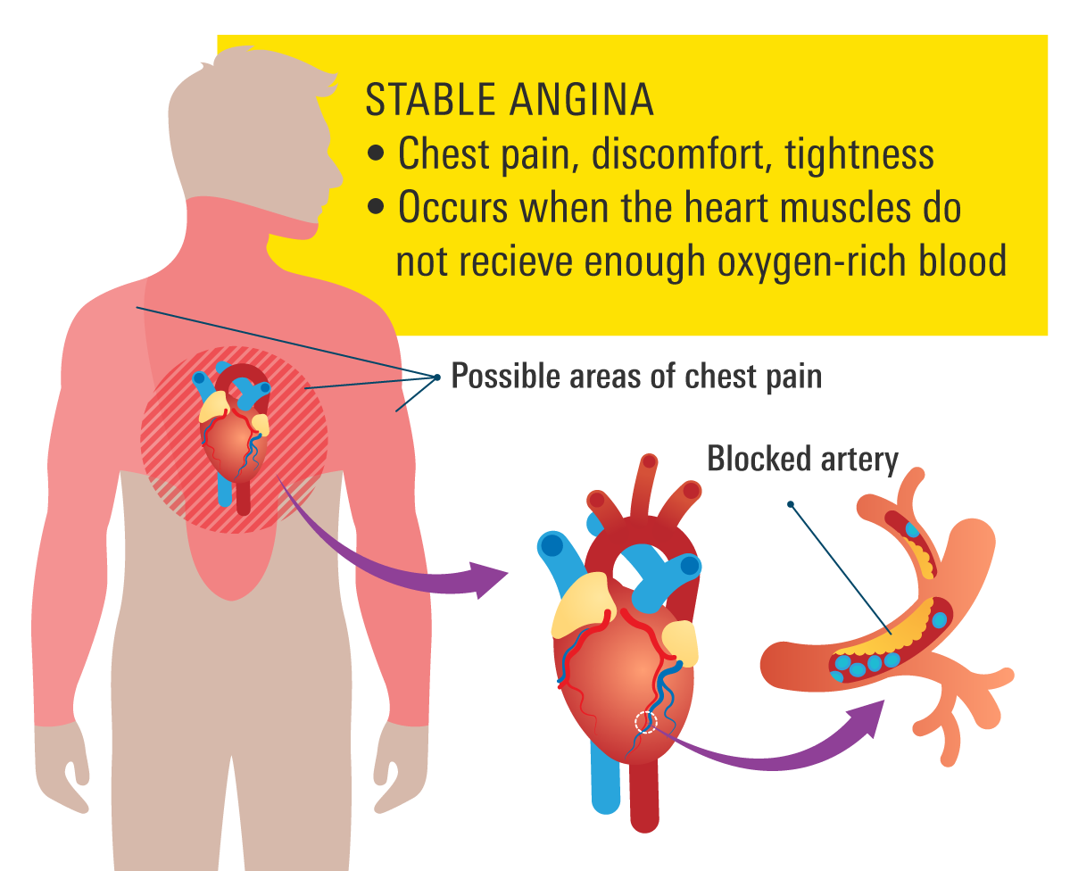 Stable angina