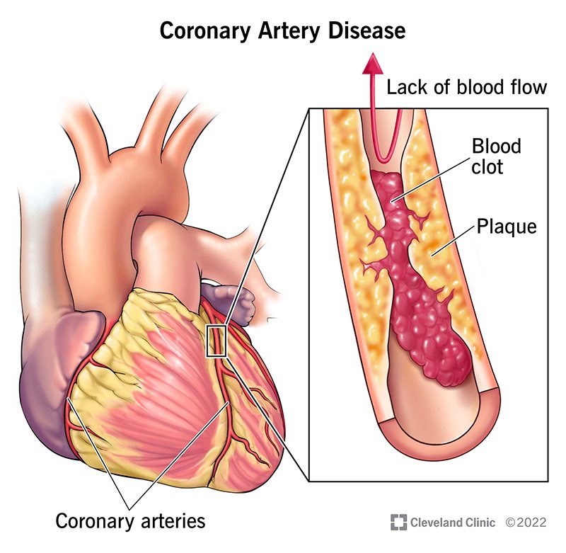 Myocardial Infarction (Heart Attack)