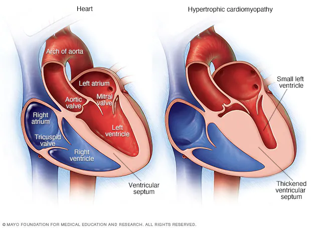 Cardiomyopathy (Dilated, Hypertrophic, Restrictive)