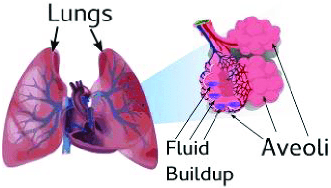 Congestive Heart Failure (CHF)