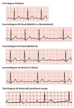 Arrhythmias (Atrial Fibrillation, Ventricular Tachycardia, Heart Block)