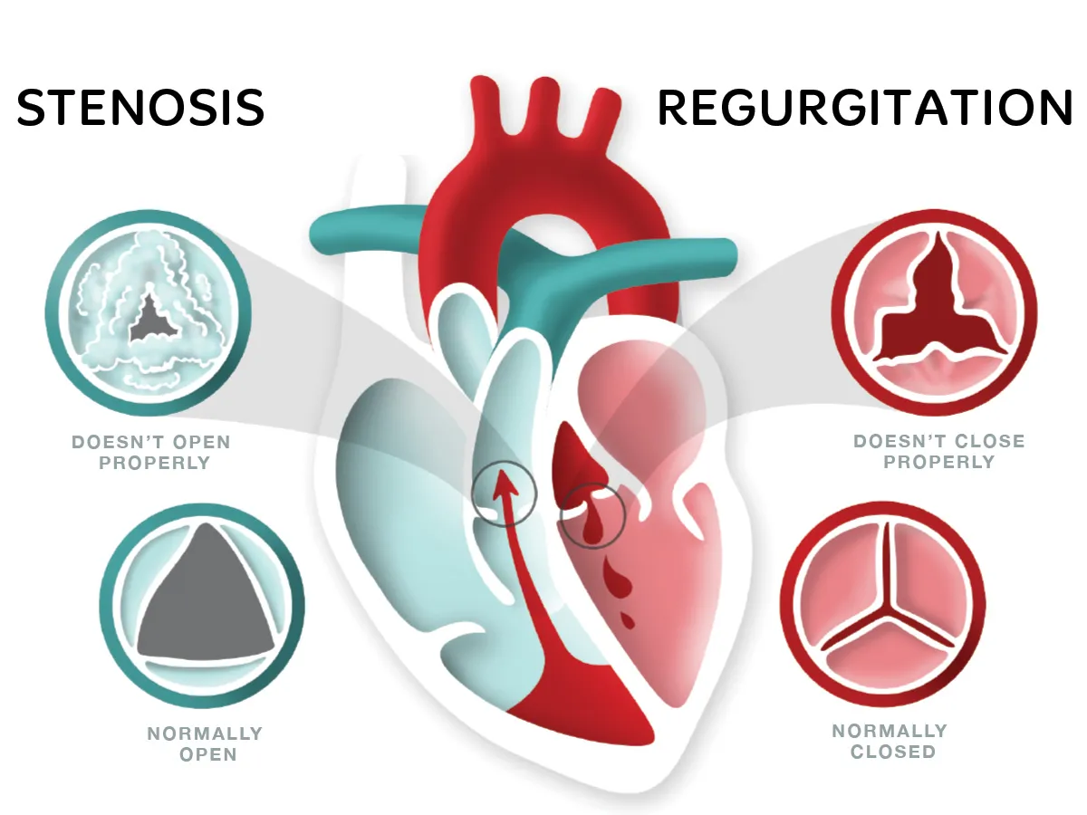 Valvular Heart Diseases (Mitral Stenosis, Mitral Regurgitation, Aortic Valve Disease)