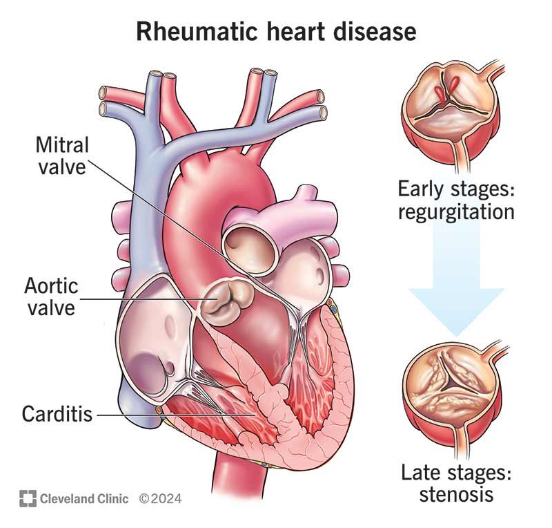 Rheumatic Heart Disease