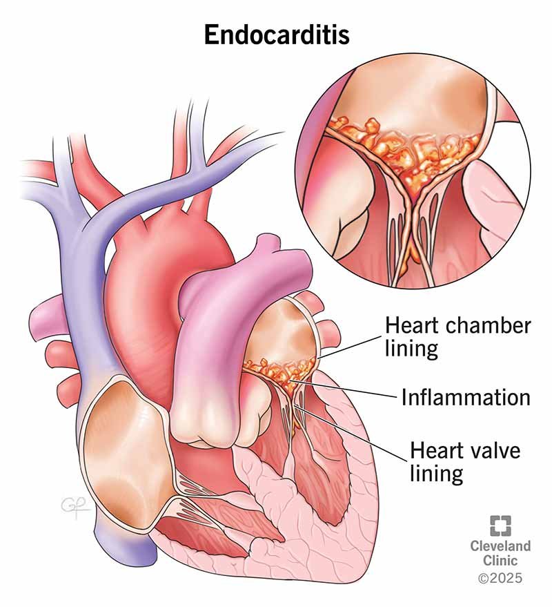 Infective Endocarditis