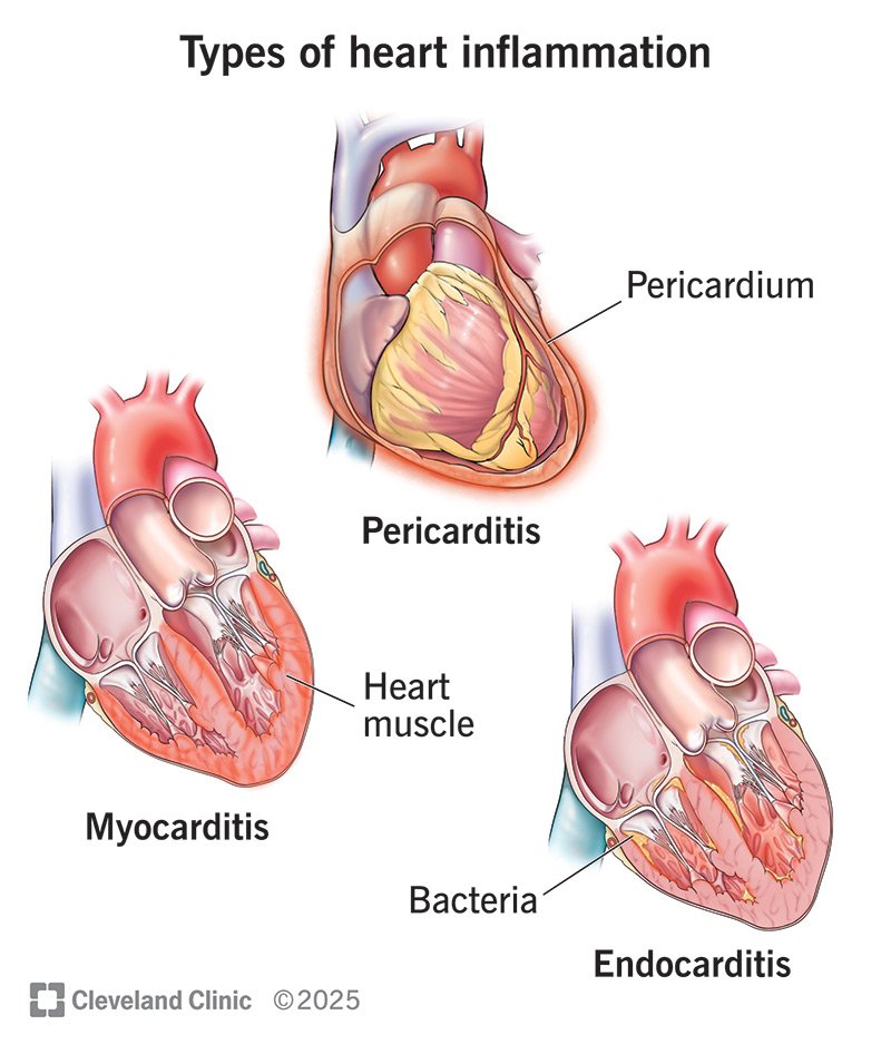 Myocarditis