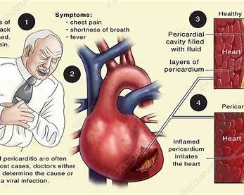 Pericarditis