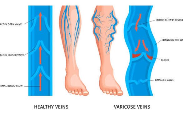 Varicose Veins