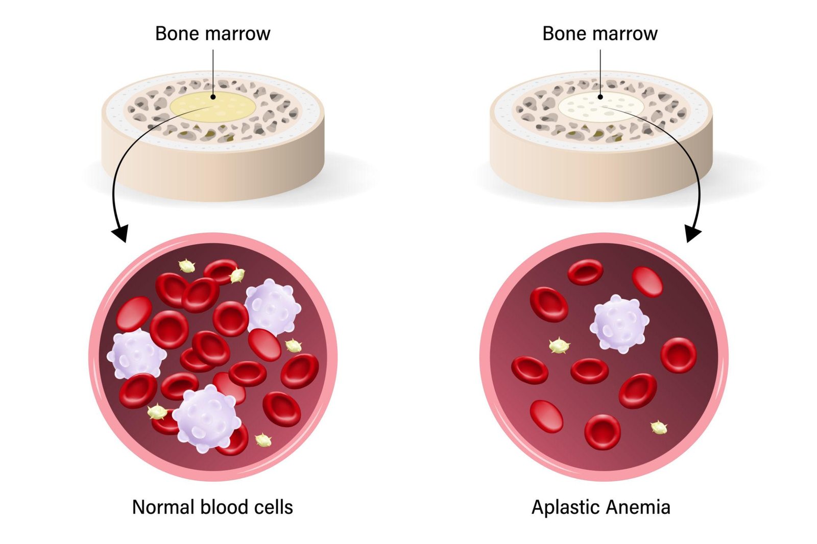 Aplastic anemia