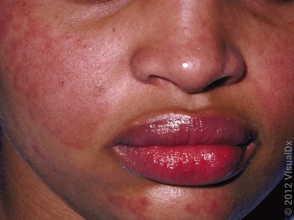 Systemic lupus erythematosus