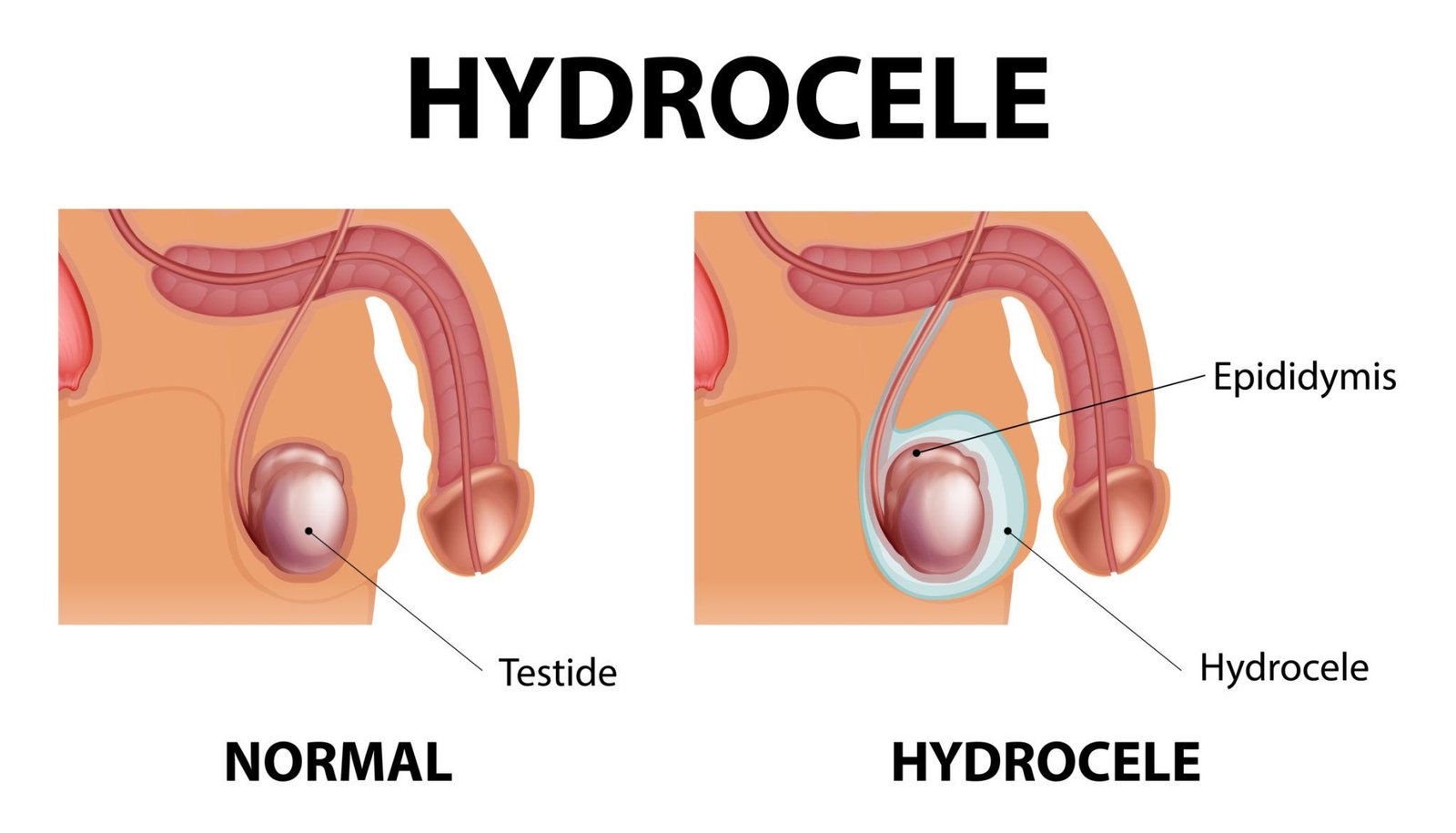 Hydrocele