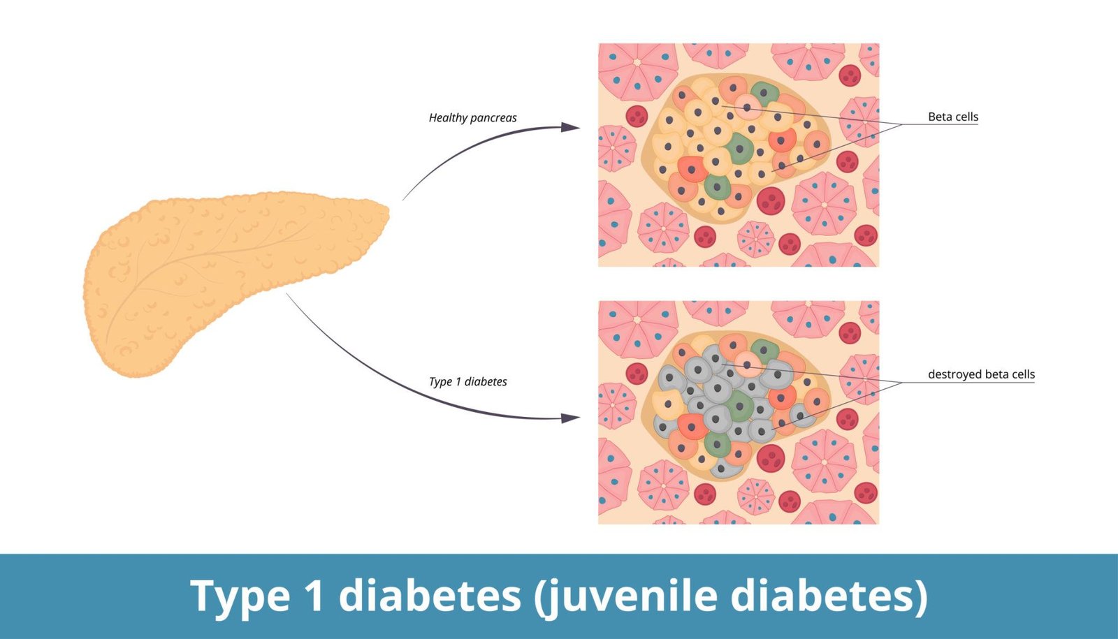 Diabetes mellitus type 1