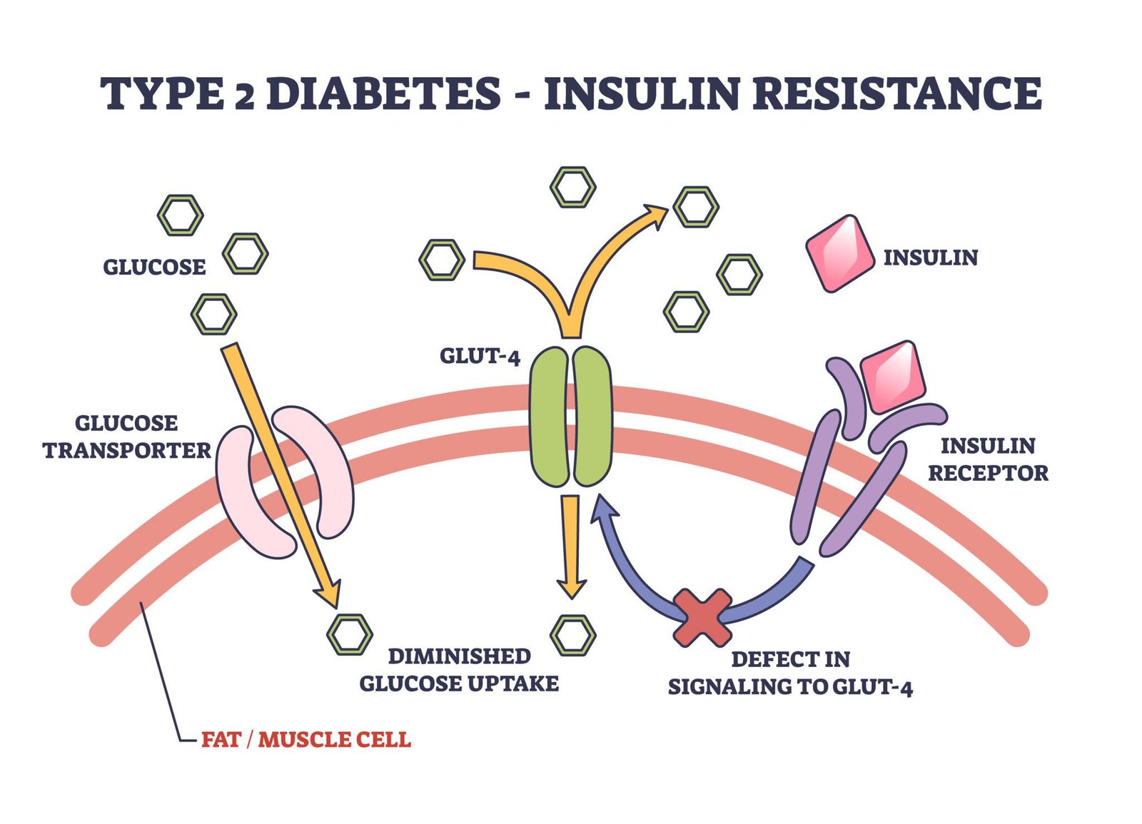 Diabetes mellitus type 2