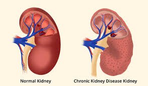 Chronic Kidney Disease