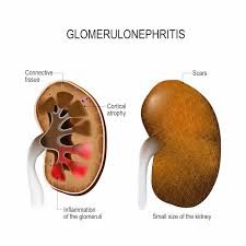 Glomerulonephritis
