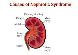 Nephrotic Syndrome